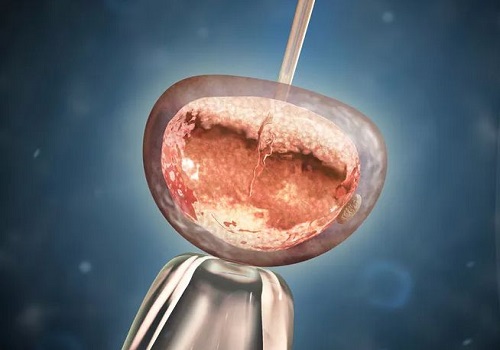 三代试管囊胚移植成功率高吗？鲜胚、冻胚、囊胚区别在哪？
